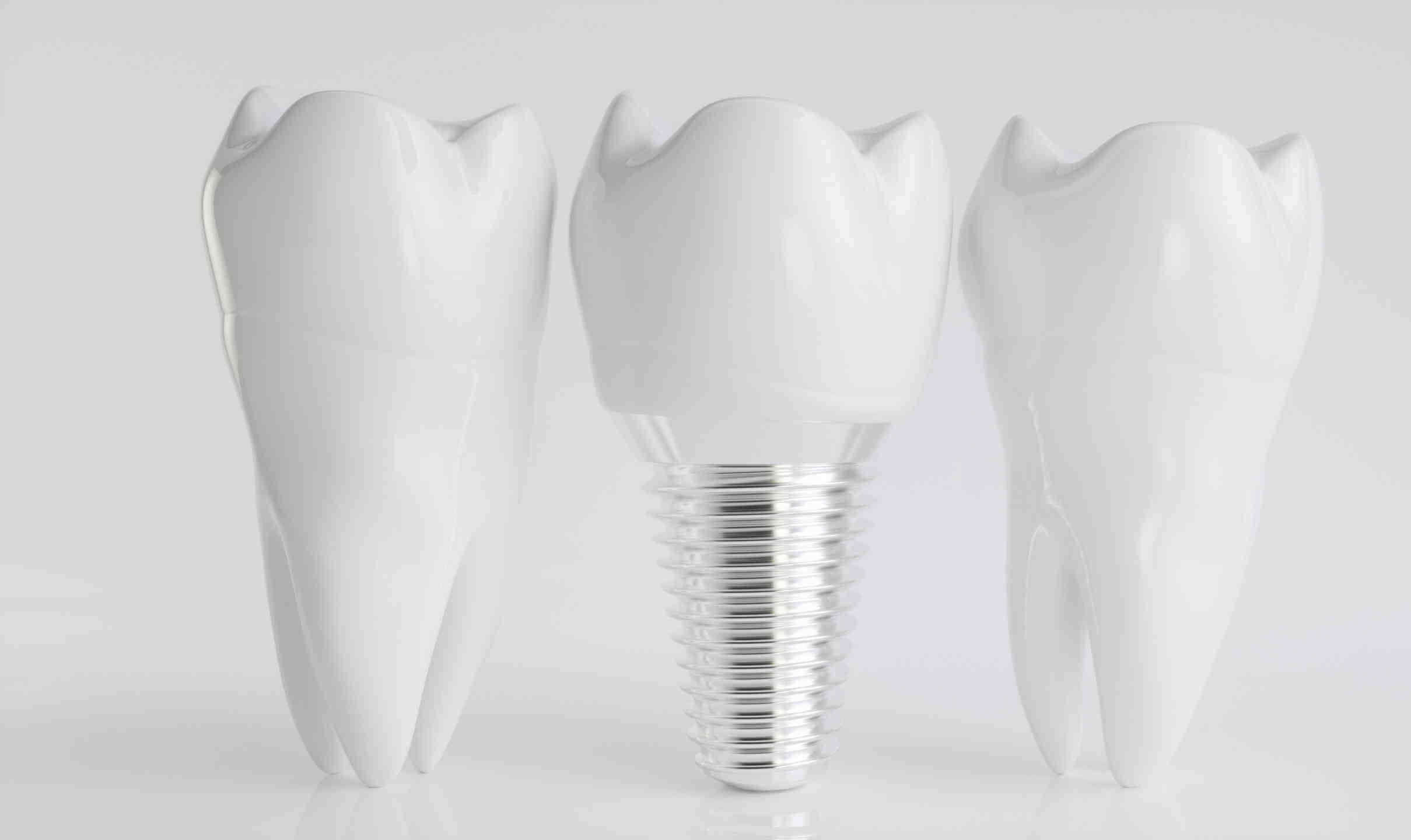 Can I get implants at a dental school?