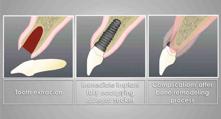 When Can I Smoke After A Flapless Dental Implant Dental News Network