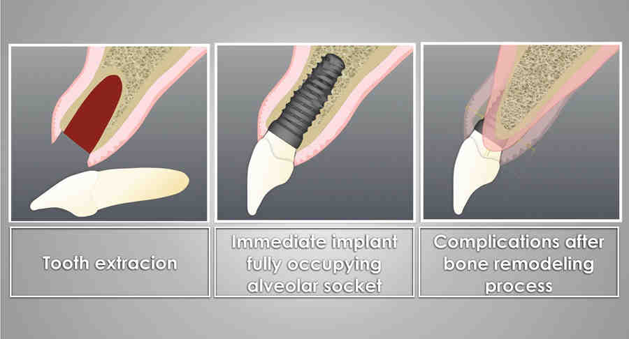 Can I smoke 2 weeks after dental implant?
