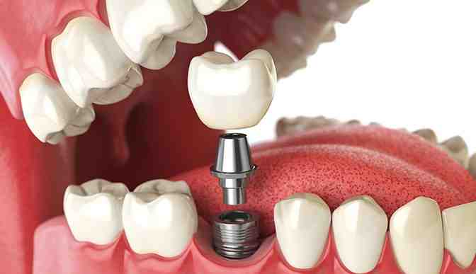 can-i-use-hsa-for-dental-implants-dental-news-network