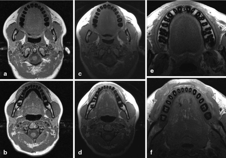 Can i have an mri with a dental implant Dental News Network