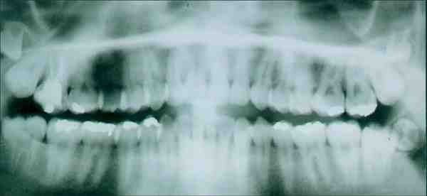 Can a cochlear implant get infected?