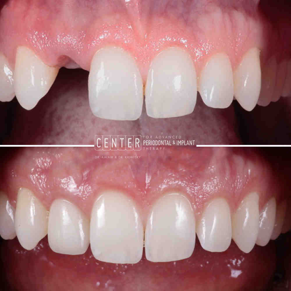 Can a crown on an implant come loose?