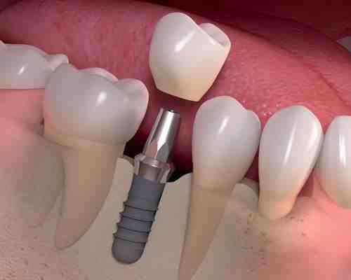 Can a general dentist do implant?