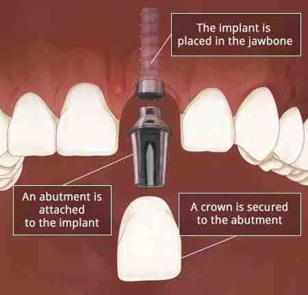 Can health be affected while waiting for dental implants after first part done