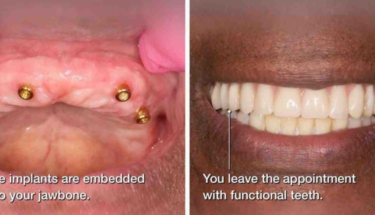 Can i drive after dental implant