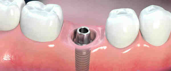 Can medical insurance pay for dental implants?