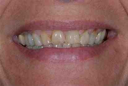 Can veneers be restorative?