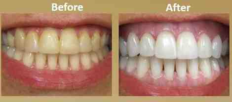 Can you claim dental implants?