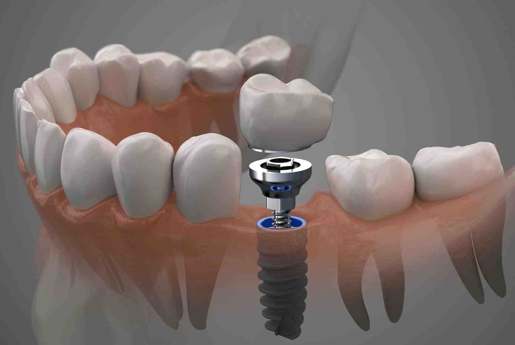 What can be done to prepare for dental implants Dental News Network