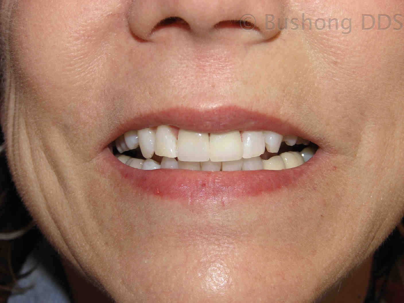 Can you get VA disability for dental?