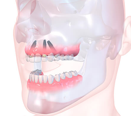 Can you get dental implants on the top?