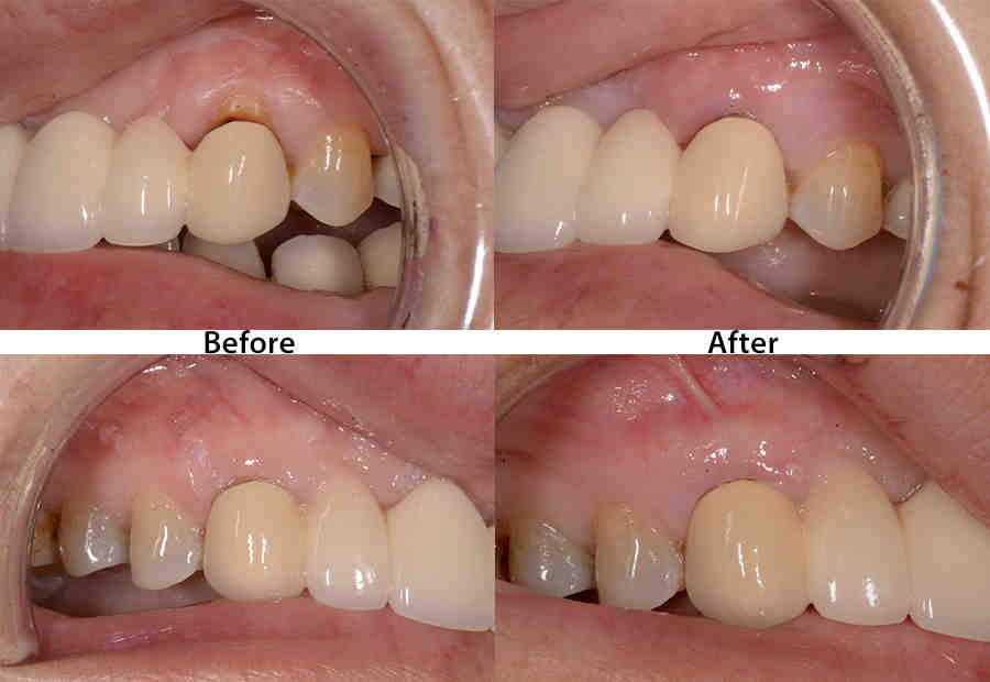 Can you have cosmetic dentistry with gum disease?