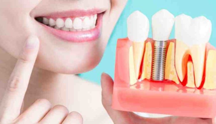Cheapist dental implants available?