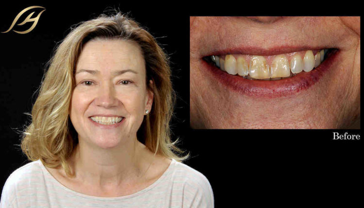 Cosmetic dentistry veneers images