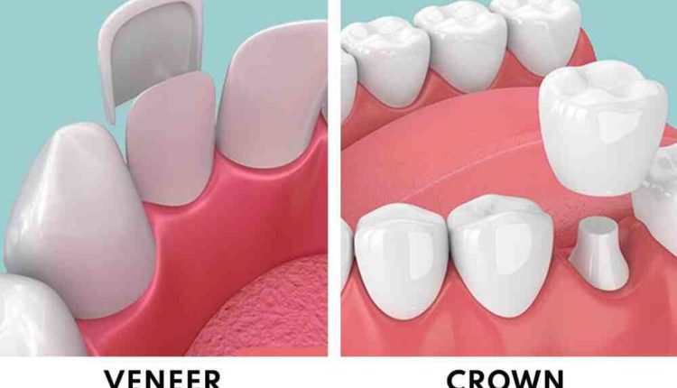 Cosmetic dentistry veneers vs crowns real self