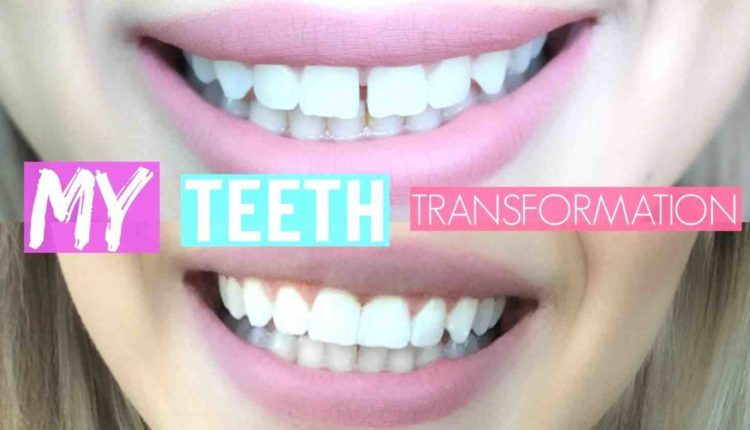 Cosmetic dentistry vlog