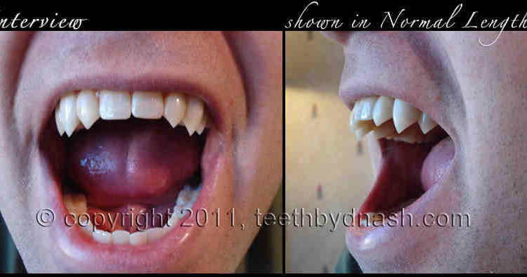 Cosmetic dentistry werewolf fanhs