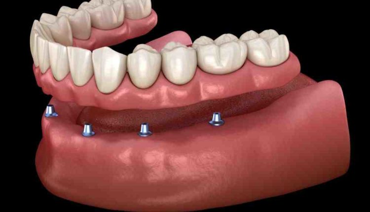 Cosmetic implant dentistry kc