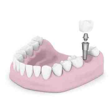 Do Medicaid pay for dental for adults?