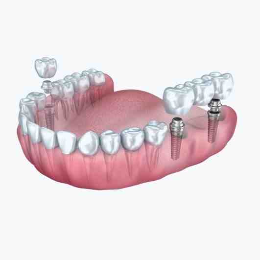 Do dental implants ever come loose?