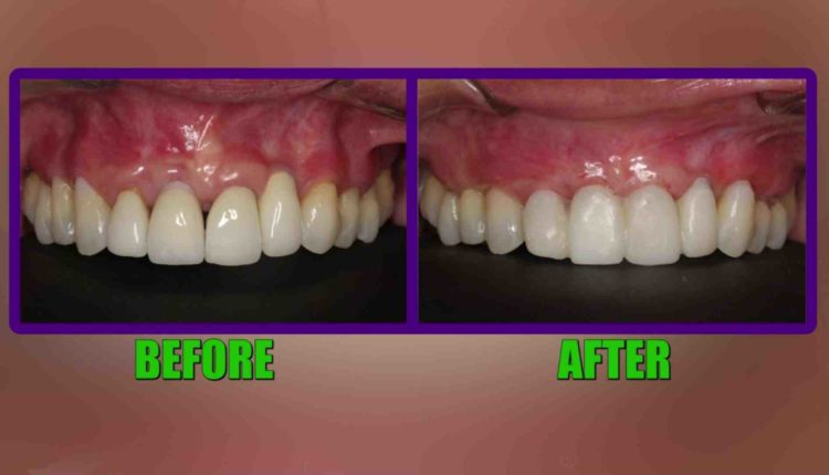 Do dental implants move