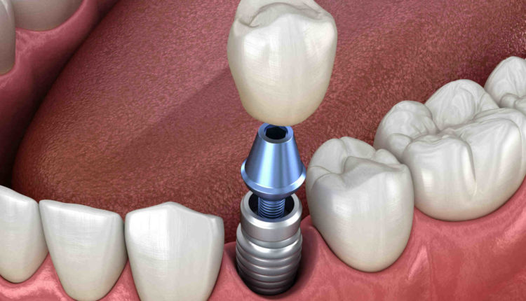 Do dental implants prevent bone loss