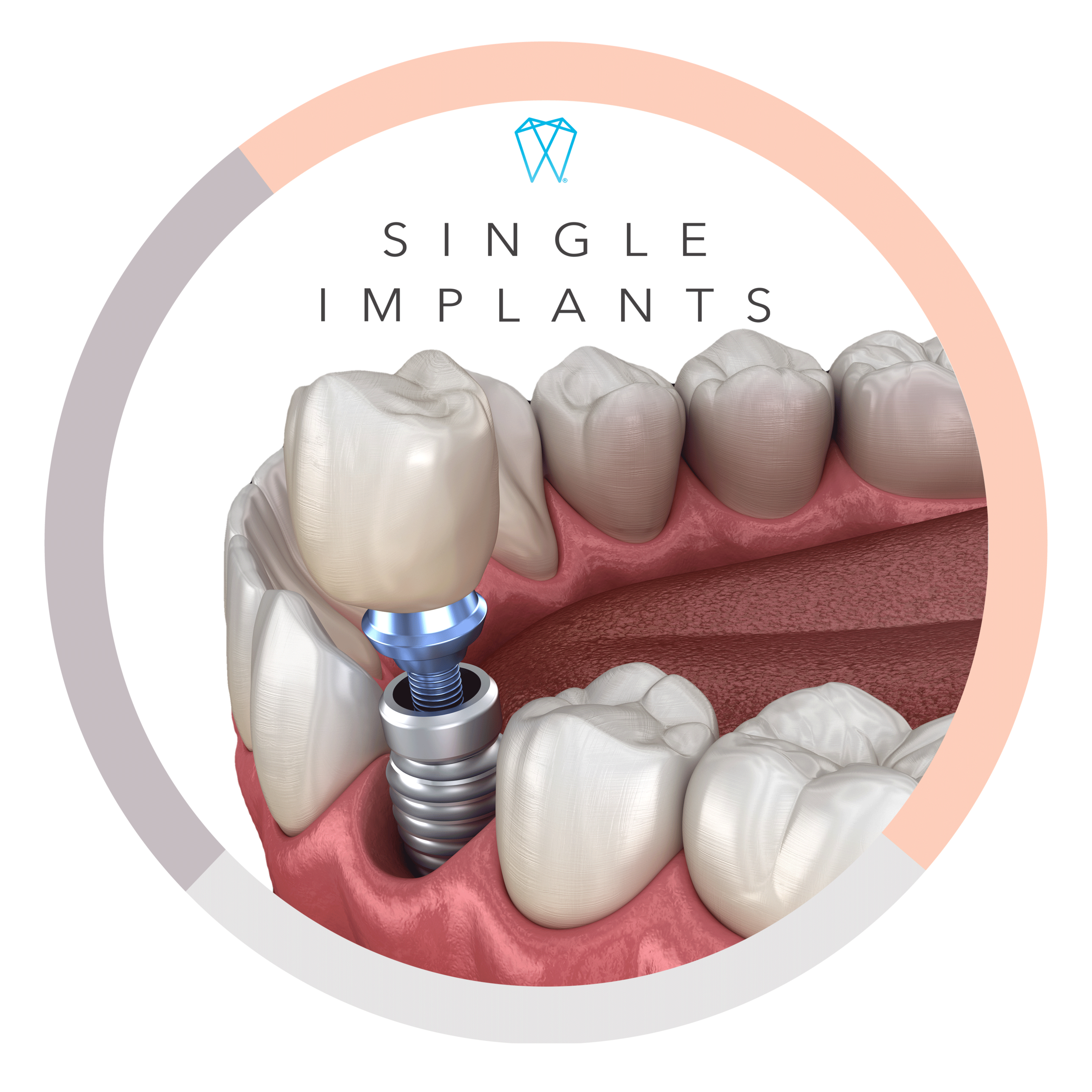 Do dental implants require general anesthesia?