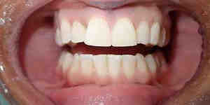 Do dentists recommend veneers?