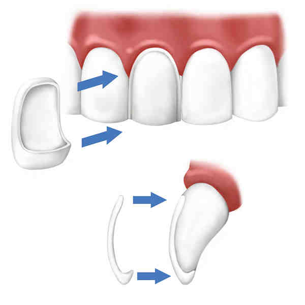 Do veneers ruin your teeth?