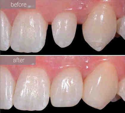 Do veneers ruin your teeth?