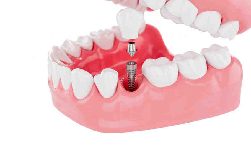 Do you have to pay for dental implants upfront?