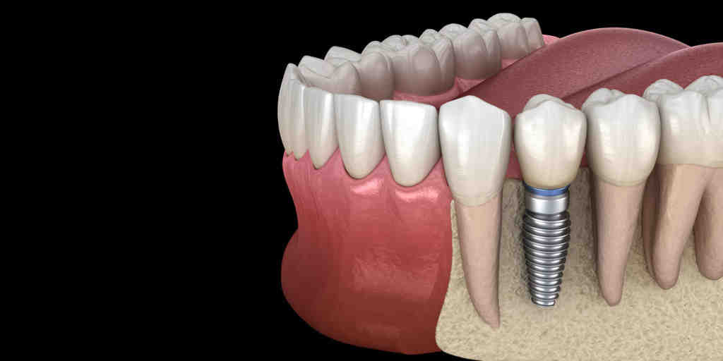 How To Tell If You Need A Bone Graft For Dental Implants - Dental News 