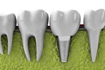 Does FEDVIP cover dentures?