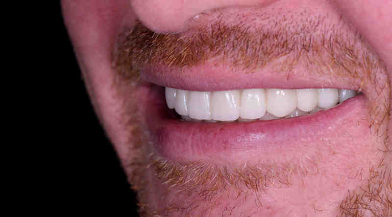 Does Medicare cover dental for adults?