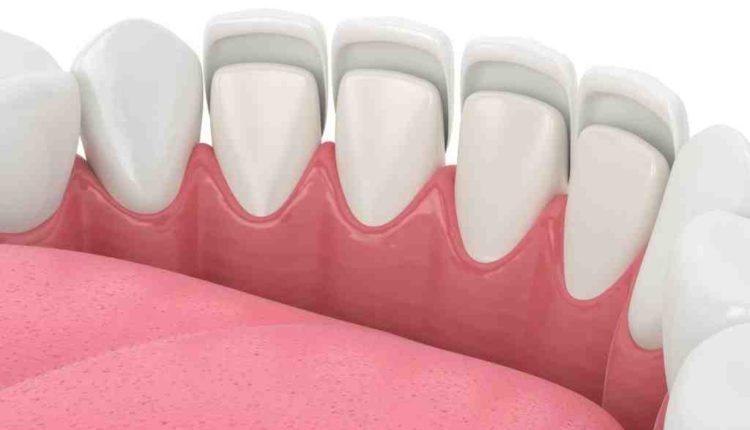 Does capital healh plan cover dental implants