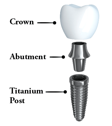 Does fedvip cover dental implants