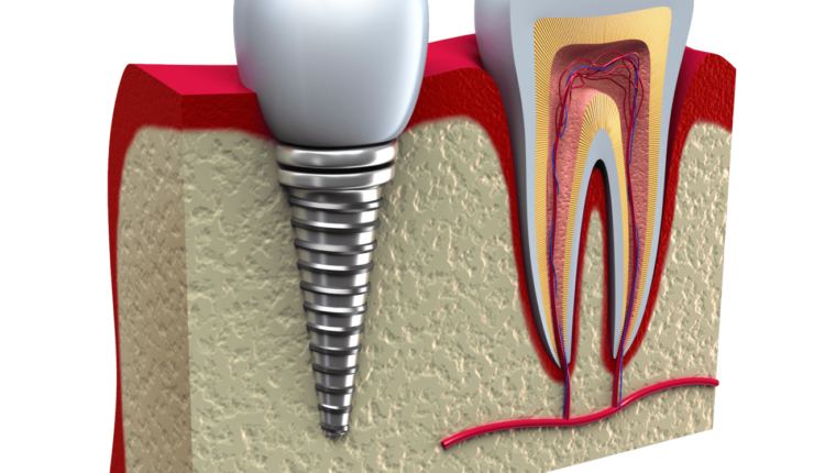 Does food get stuck in dental implants