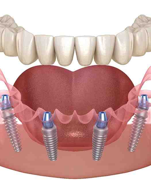 How to care for all on 4 dental implants - Dental News Network