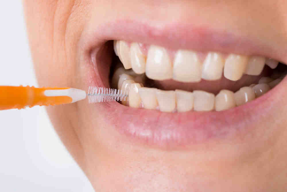 How to clean dental implants properly Dental News Network