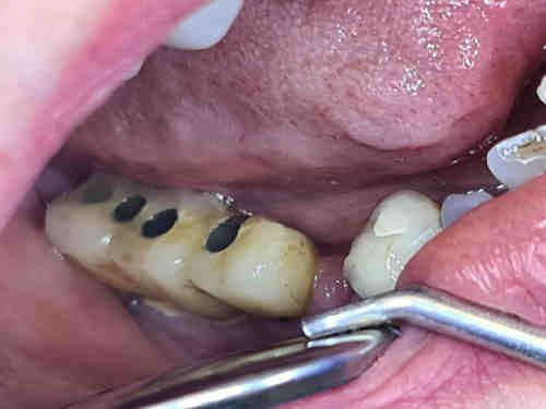 Does food get under all on 4 dental implants?