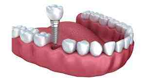 Does it feel weird to have dental implants?