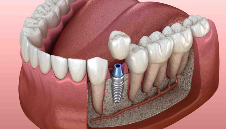 Does mayo medica cminsurance cover dental implants