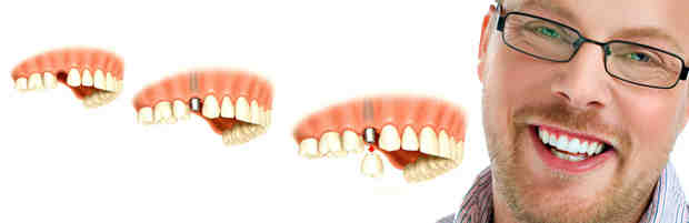 How can I get dental implants for free?