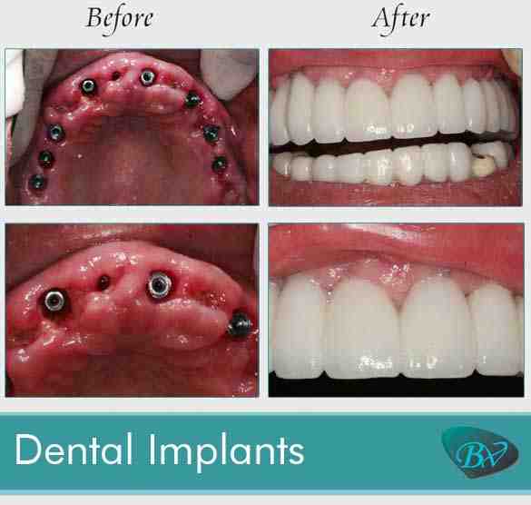 How can I get dental implants with no money?