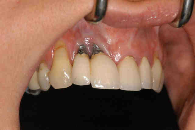 How can I make my dental implant heal faster?