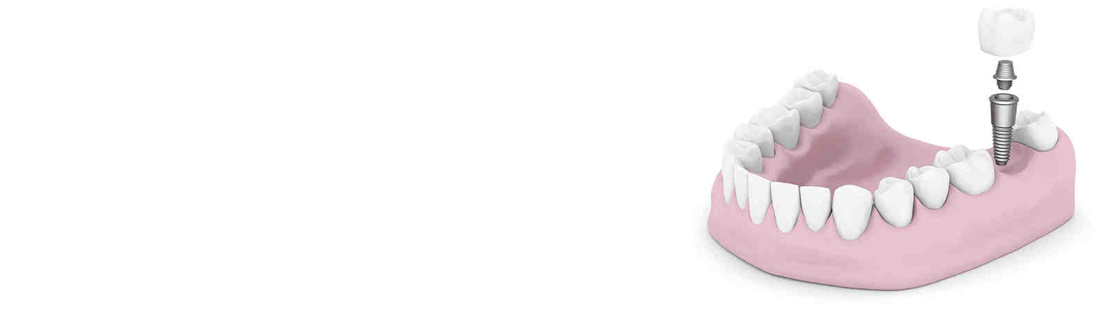 How common are dental implants?