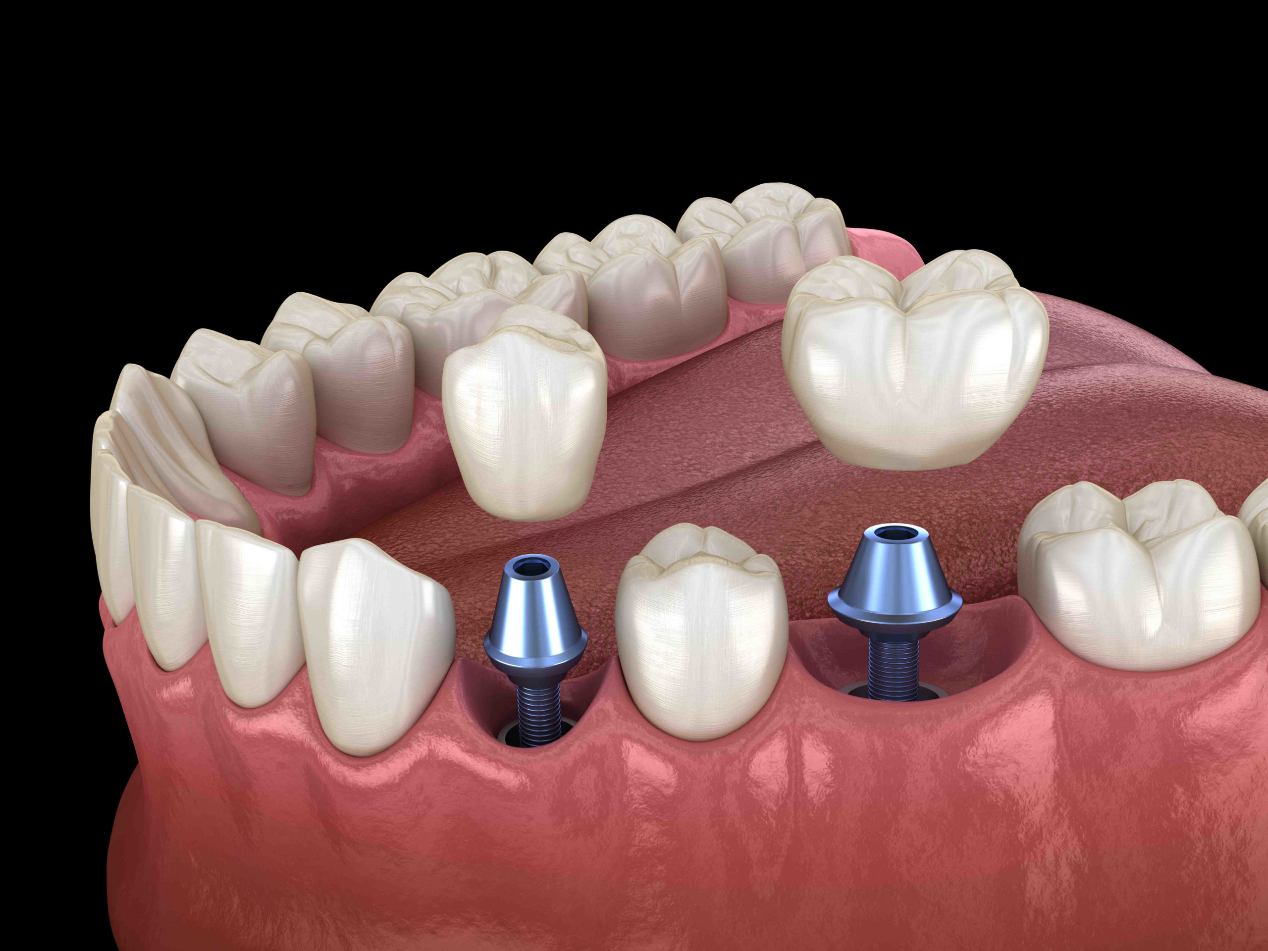 How difficult are dental implants?