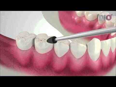 How do I choose a dental implant specialist?