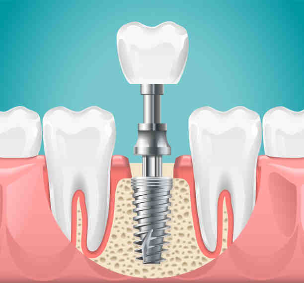How do they fix bone loss around dental implants?